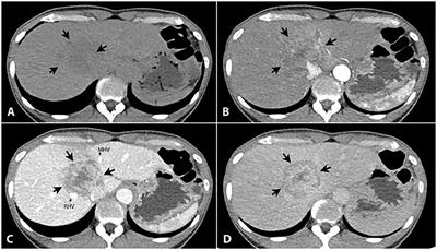 Favorable outcome of immunotherapy in a rare subtype of hepatocellular carcinoma: a case report and literature review
